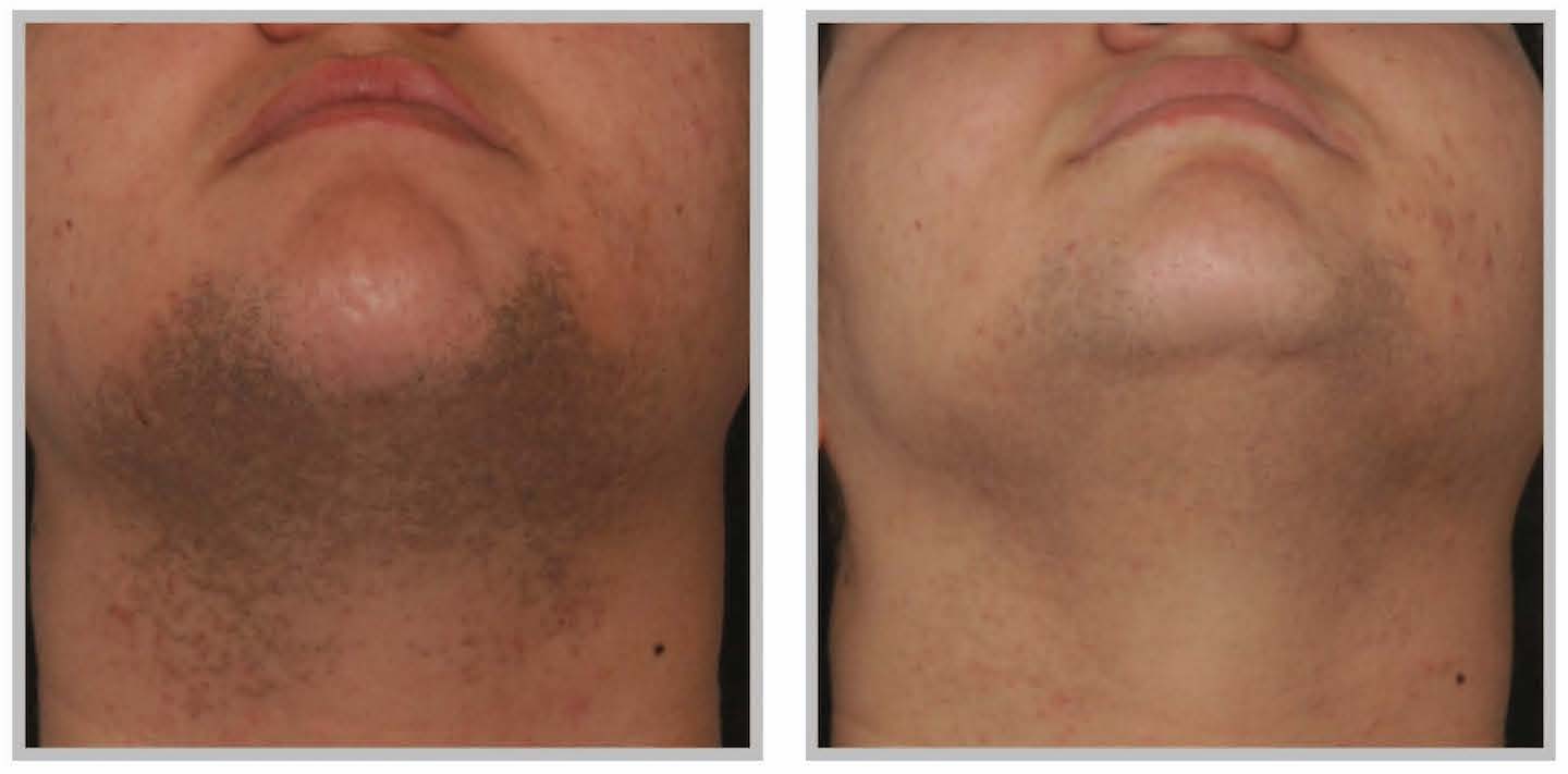 laser_hair_removal_2